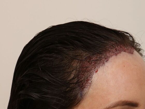 Hair Transplant - Female Hairline FUT - Case 15 - Before