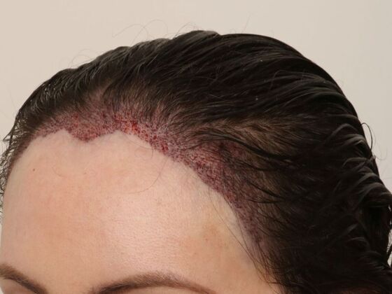 Hair Transplant - Female: Hairline FUT - Case 15 - Post-op female hair transplant