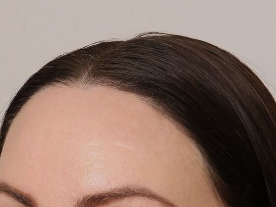 Hair Transplant - Female: Hairline FUT - Case 15 - After female hair transplant