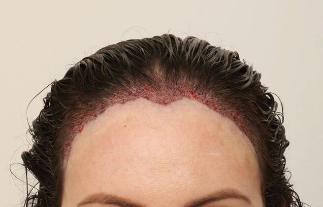 Hair Transplant - Female: Hairline FUT - Case 15 - Post-op female hair transplant