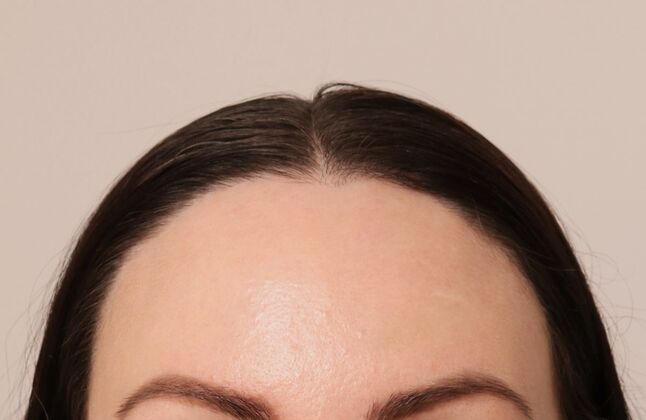 Hair Transplant - Female: Hairline FUT - Case 15 - After female hair transplant