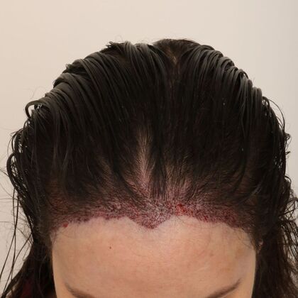 Hair Transplant - Female: Hairline FUT - Case 15 - Post-op female hair transplant