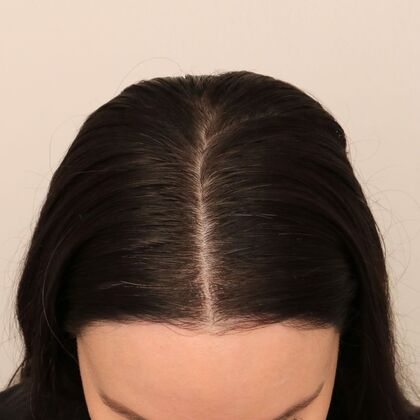 Hair Transplant - Female: Hairline FUT - Case 15 - After female hair transplant