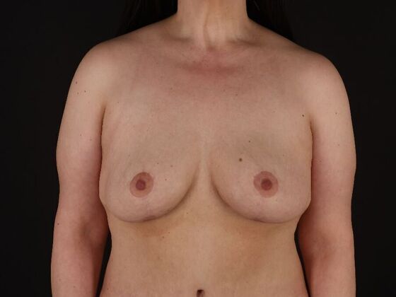 Breast Lift & Breast Lift Augmentation Case 60 - After