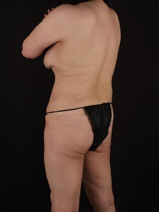 Liposuction: Case 63 - After