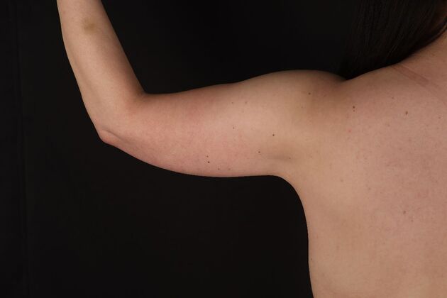 Arm Lift & Reduction: Case 14 - After