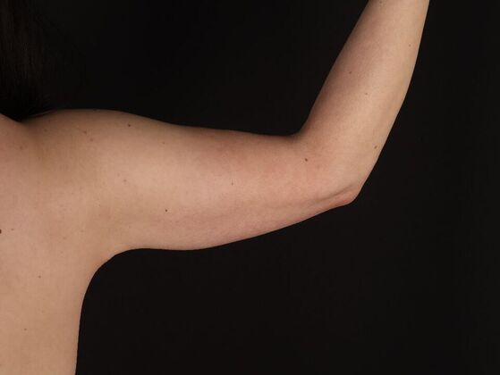 Arm Lift & Reduction: Case 14 - After