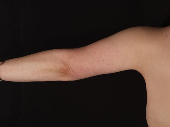 Arm Lift & Reduction: Case 14 - After