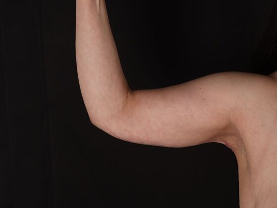 Arm Lift & Reduction: Case 14 - After