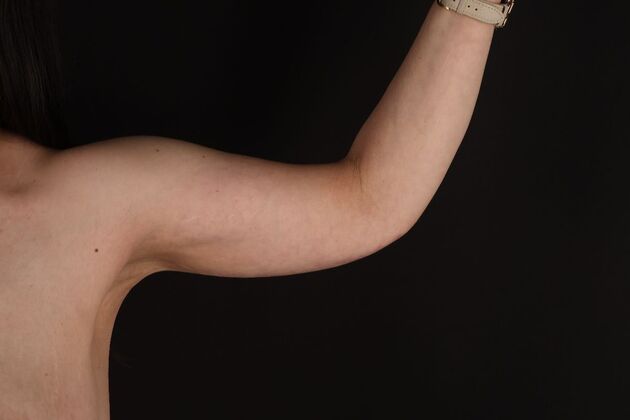 Arm Lift & Reduction Case 14 - After