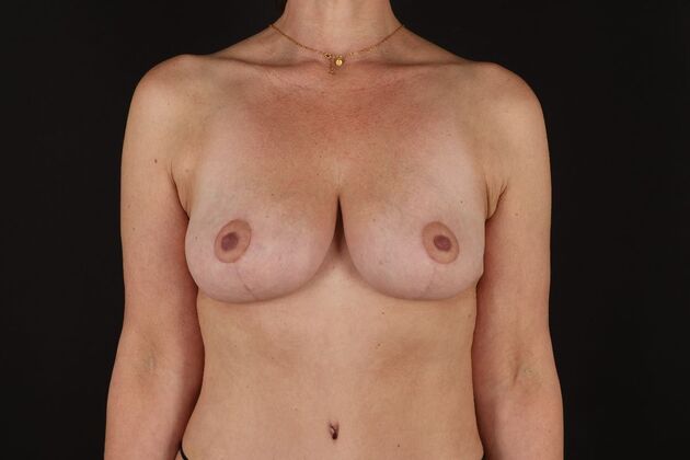 Breast Reduction & Lift Case 42 - After