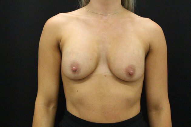 Breast Revision Case 22 - Before