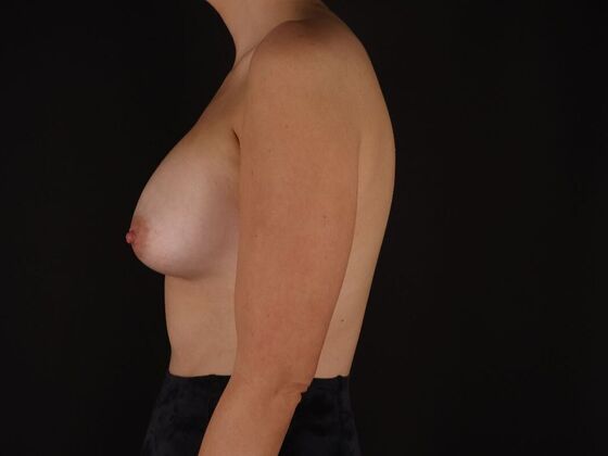 Breast Augmentation: Case 57 - After