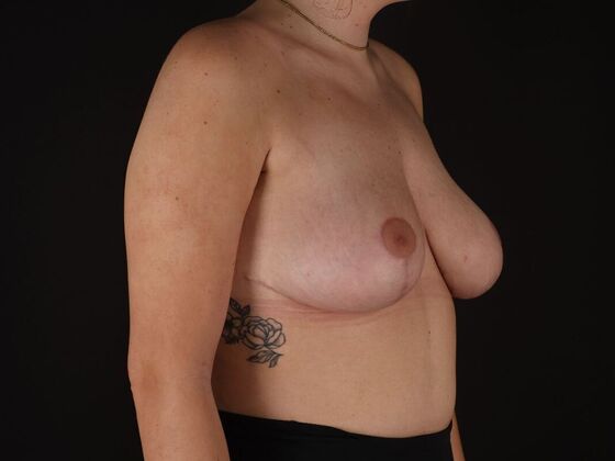 Breast Lift & Breast Lift Augmentation: Case 72 - After