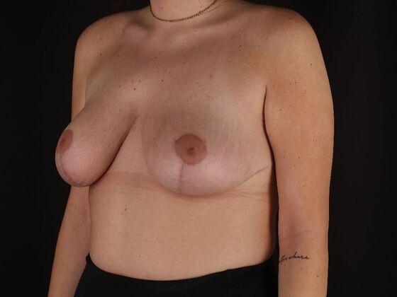 Breast Lift & Breast Lift Augmentation: Case 72 - After