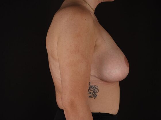 Breast Lift & Breast Lift Augmentation: Case 72 - After