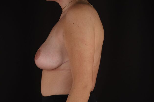 Breast Lift & Breast Lift Augmentation: Case 72 - After