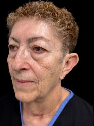 Face & Neck Lifts: Facelift 2 - Before