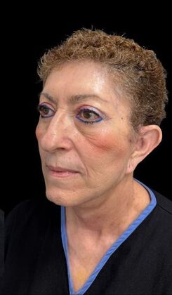 Face & Neck Lifts: Case 3 - After