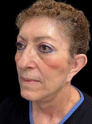 Face & Neck Lifts: Facelift 2 - After