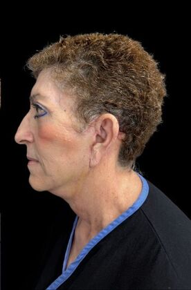 Face & Neck Lifts: Case 3 - After