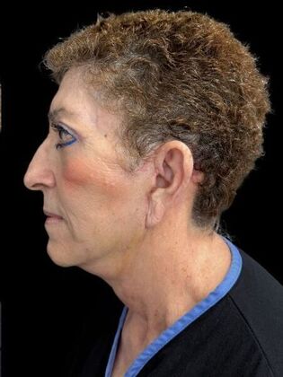 Face & Neck Lifts: Facelift 2 - After