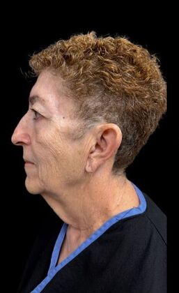 Face & Neck Lifts: Case 3 - Before