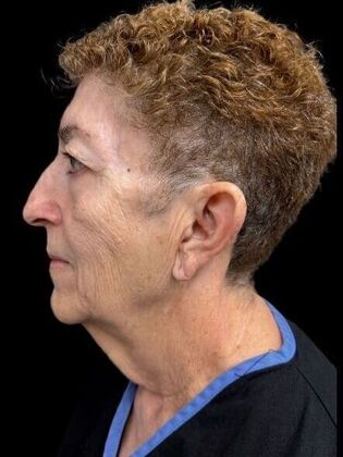 Face & Neck Lifts: Facelift 2 - Before