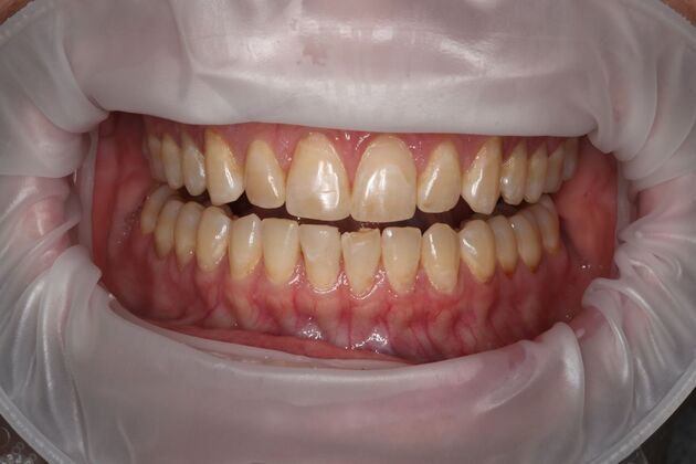 Full Mouth Reconstruction: Case 6 - Before