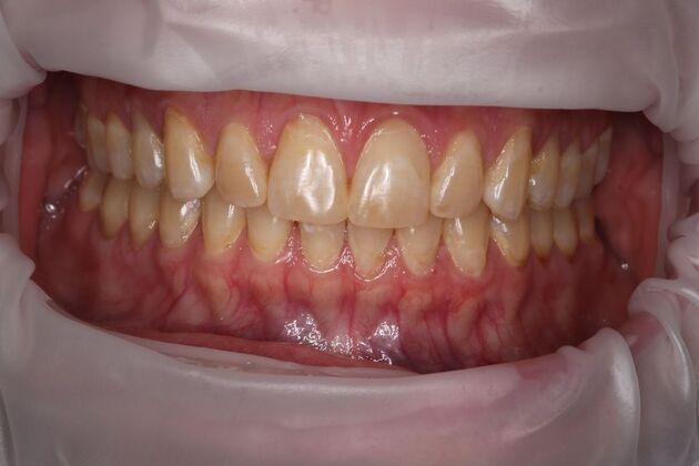 Full Mouth Reconstruction: Case 6 - Before