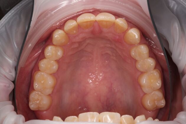 Full Mouth Reconstruction: Case 6 - Before