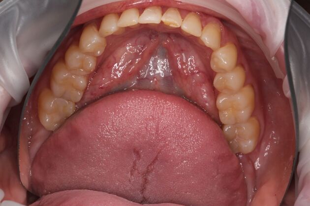 Full Mouth Reconstruction: Case 6 - Before