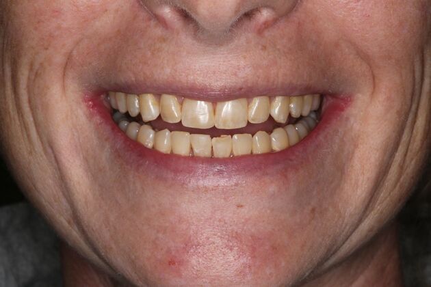 Full Mouth Reconstruction: Case 6 - Before
