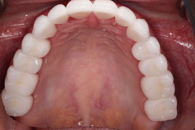 Full Mouth Reconstruction: Case 6 - After
