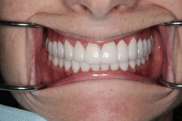 Full Mouth Reconstruction: Case 6 - After