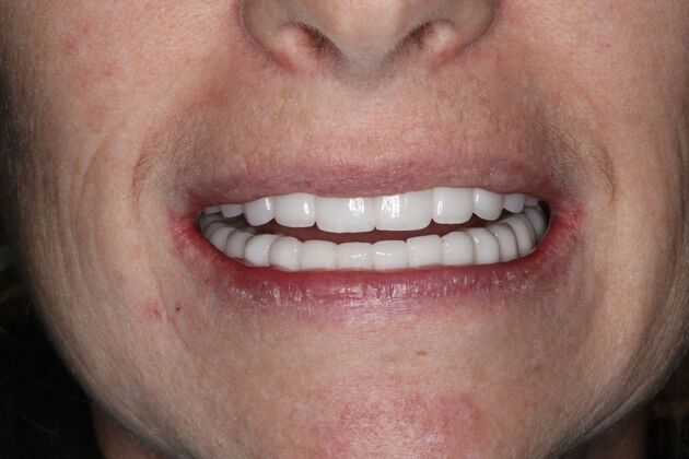 Full Mouth Reconstruction: Case 6 - After