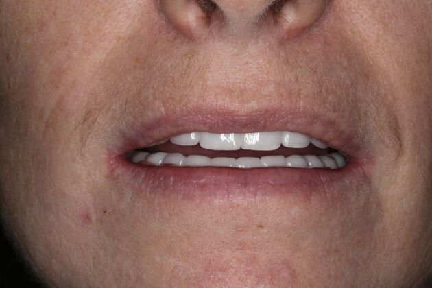 Full Mouth Reconstruction: Case 6 - After