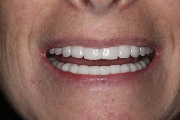 Full Mouth Reconstruction: Case 6 - After