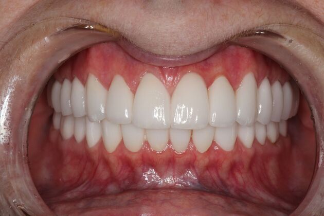 Full Mouth Reconstruction: Case 6 - After