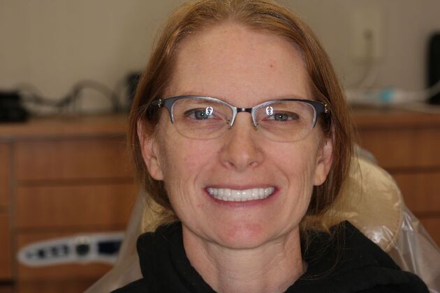 Full Mouth Reconstruction: Case 6 - After