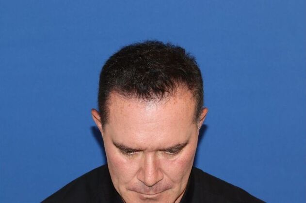 Hair Transplants Case 16 - Hairline Restoration - Before