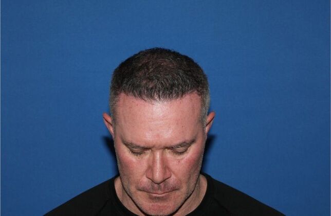 Hair Transplants Case 16 - Hairline Restoration - After