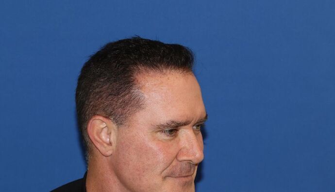 Hair Transplants: Case 16 - Hairline Restoration - Before