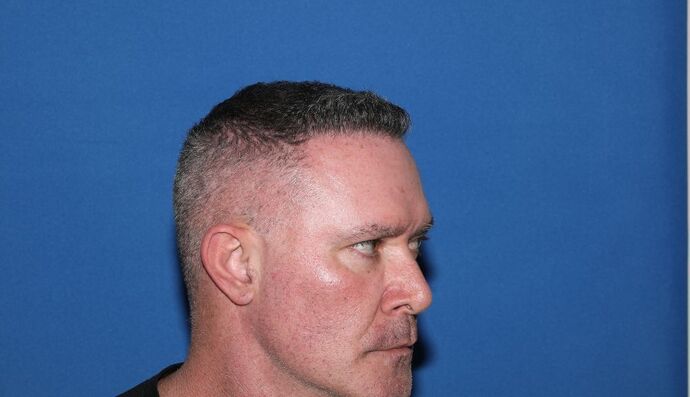 Hair Transplants: Case 16 - Hairline Restoration - After