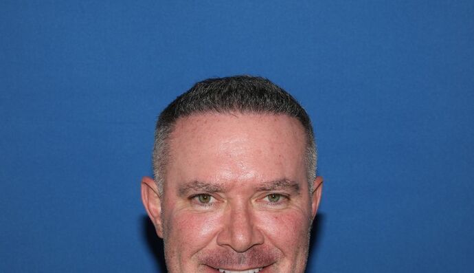 Hair Transplants: Case 16 - Hairline Restoration - After