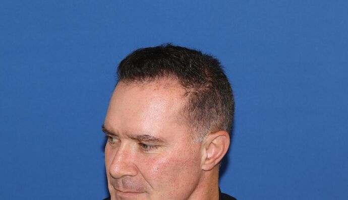 Hair Transplants: Case 16 - Hairline Restoration - Before