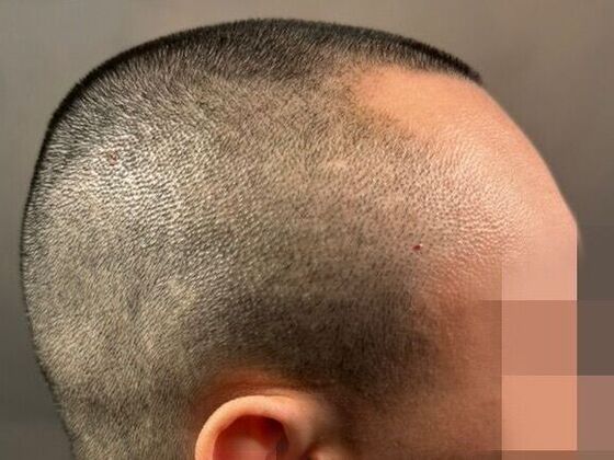 Hair Transplant Results: Case 7 - Before