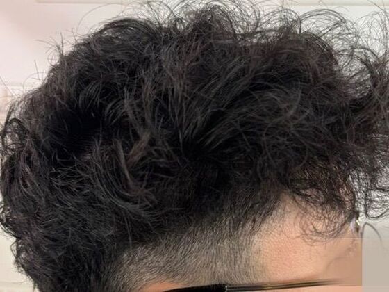 Hair Transplant Results: Case 7 - After