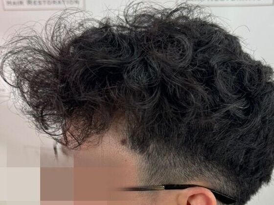 Hair Transplant Results: Case 7 - After