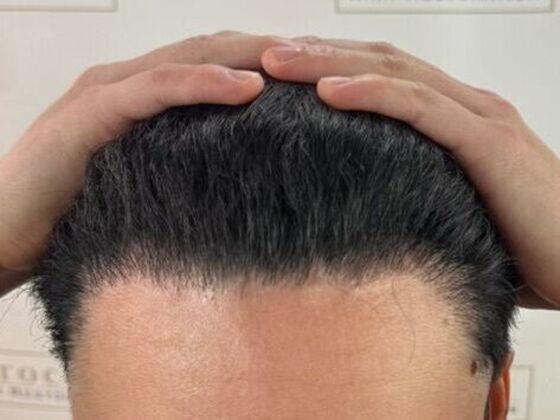 Hair Transplant Results Case 7 - After